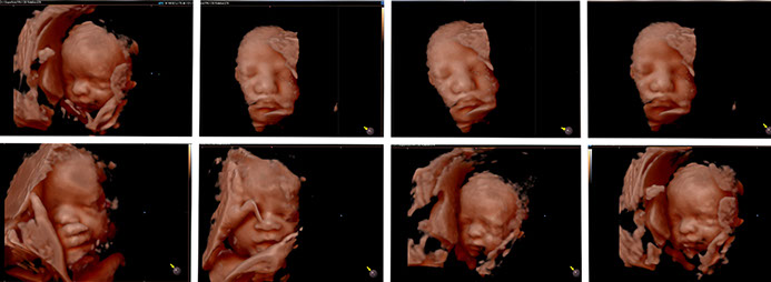 Ecografía 3D, 4D y 5D en Femsalud